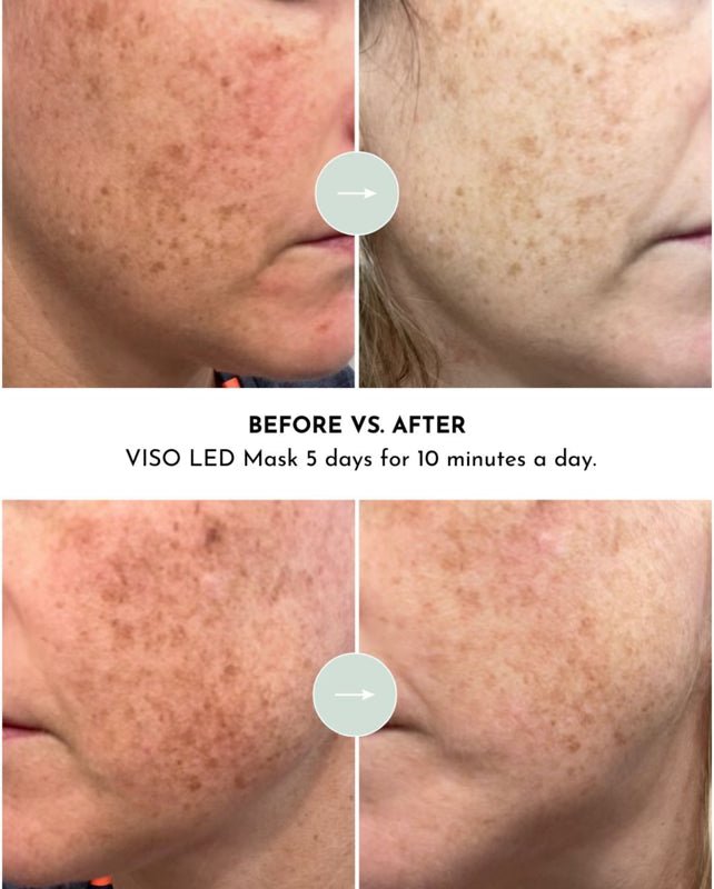 VISO - FDA Certified Red Light Therapy Mask - urbinfinds